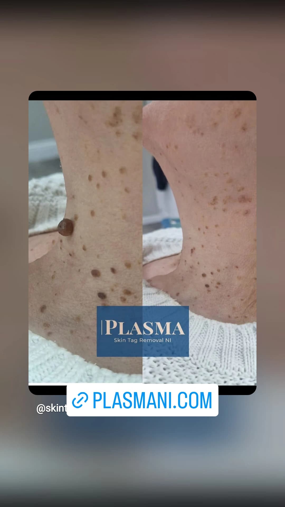 Plasma Skin Tag & Lesion Removal Clinic NI in Lisburn